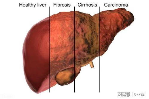 10岁男童重度肝硬化,妈妈后悔痛哭 怪我 是我一口一口喂出来的