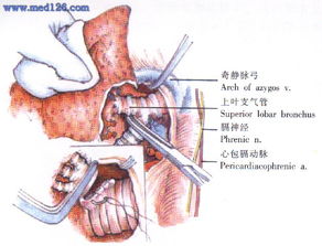 肺叶切除术操作步骤,图片图谱图解,手术治疗方法,诊断肺手术 