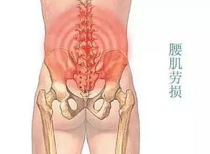 腰肌劳损是怎样形成的 怎么有效去治疗