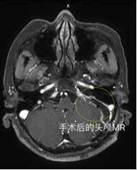 头晕 耳鸣 左侧听力逐渐下降加重, 大意以为是遗传,体检意外发现脑里面竟长个肿瘤