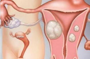 什么是多发性子宫肌瘤