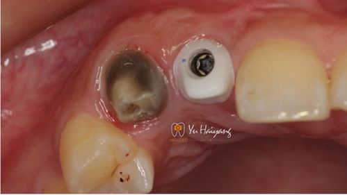 右上前牙牙冠折即刻种植修复1例