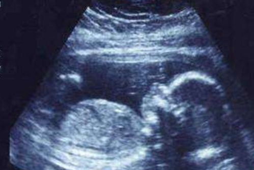 孕早期做b超没有憋尿会影响结果吗
