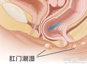 肛门湿疹怎么手术切除