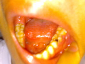 牙齿有个洞会出血 