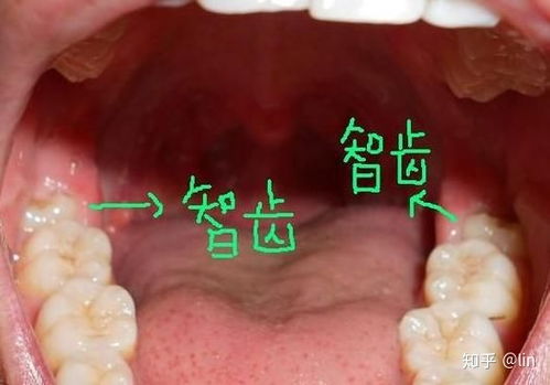 智牙不拔能怎么样 古代人都怎么处理智牙 