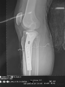 右侧胫骨中上段粉粹性骨折 图片信息欣赏 图客 Tukexw Com