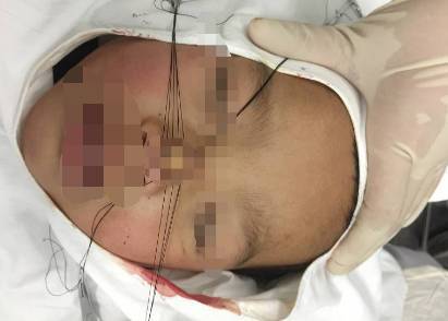 心疼 3岁男孩鼻头被镜子削掉,妈妈捡起鼻肉冲向医院跑 医生说,遇到这种情况应该这样处理 