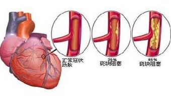 冠心病最佳的治疗方法是什么