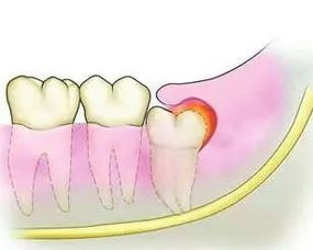 如何解决智齿疼痛(怎样解决智齿疼痛)