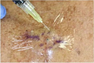 短暂应用透明胶膜敷料预防皮肤外科手术局部麻醉注射时回溅