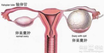 囊肿多大要做手术