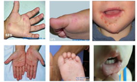 手足口病症状(手足口病的症状是什么)