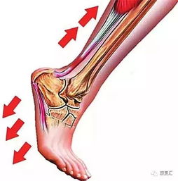 跟痛症的病因和康复治疗 