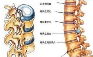 怎么才能远离腰椎间盘突出带来的危害 