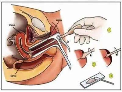 TCT和HPV检查貌似都一样,到底查哪个