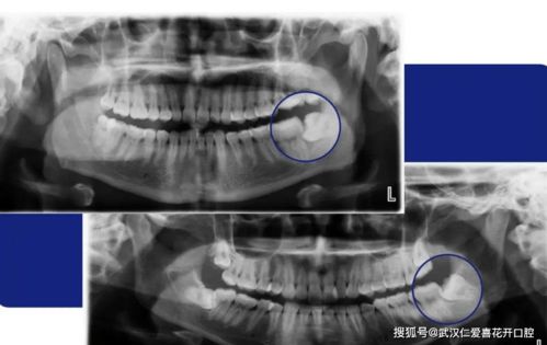 为啥总有人觉得看牙贵 三个字 拖太久