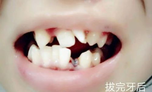 正畸医生刘芳 如何确定自己牙齿矫正时需不需要拔牙