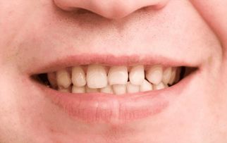 有种尴尬丑叫 牙齿发黄 , 嘴巴常嚼一种钙, 牙齿7天就美白 