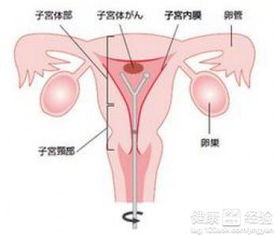 子宫癌的早期症状