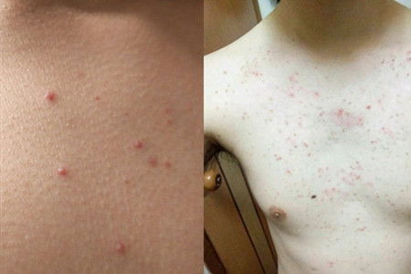 为什么胸口上会长红色痘痘,详解其因素 