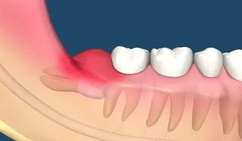 牙龈肿痛怎么办 健康师总结6个消肿止痛办法