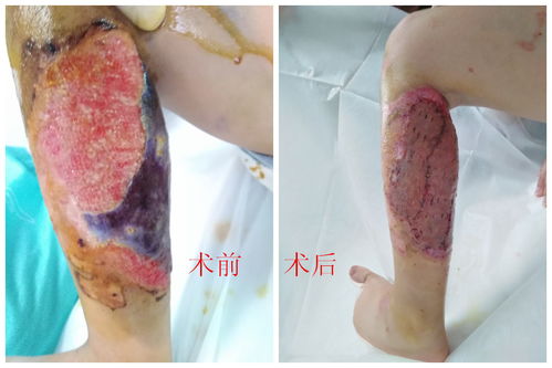 4岁男孩被开水烫伤 闽东医院医生取头皮修复患处