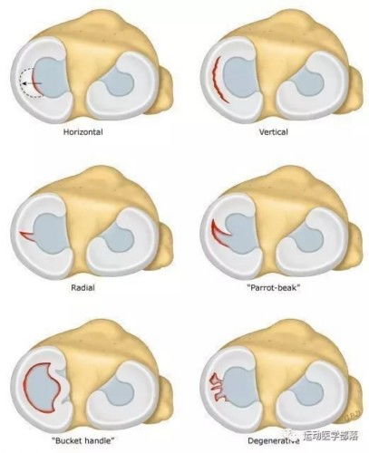 半月板撕裂图片百科 米粒分享网 Mi6fx Com