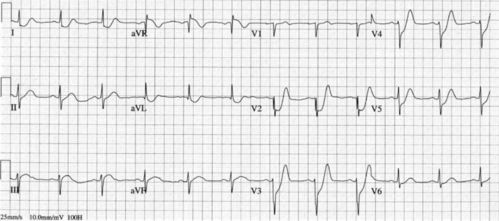 窦性心律 ST T轻度改变是什么意思