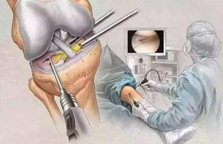 膝关节内侧副韧带损伤怎么办 运动医学宋斌