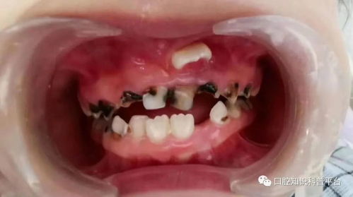 乳牙 为什么比 恒牙 更容易 坏