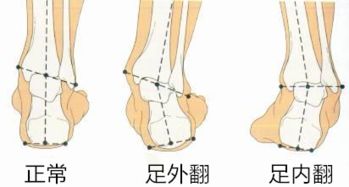 跑步怎样区分内外翻脚 