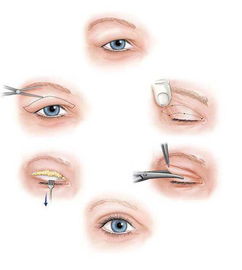 注意这几件事让你双眼皮手术效果最大化