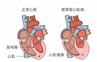 心源性猝死 若存有这种病心脏骤停后几乎救不回