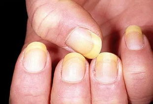 从指甲的10种状态看出你的健康状况