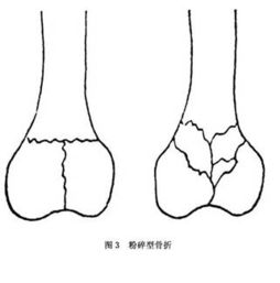 股骨髁骨折详情页,股骨髁骨折哪家医院看得好 治疗股骨髁骨折哪个医生好 股骨髁骨折推荐医院医生 微医 挂号网 