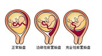 胎盘前置和胎盘后置,哪个对胎儿比较好 看完可能你就知道了