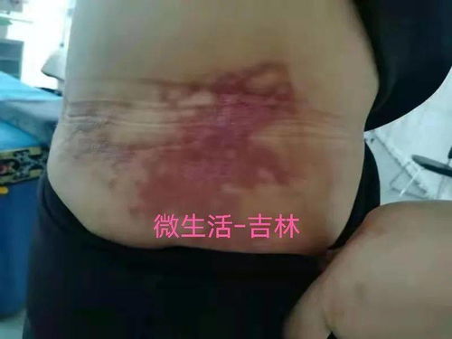 网友求助 吉林市一女子在医美整形门诊部做抽脂手术,成片瘢痕留在腰腹间,该怎么办 