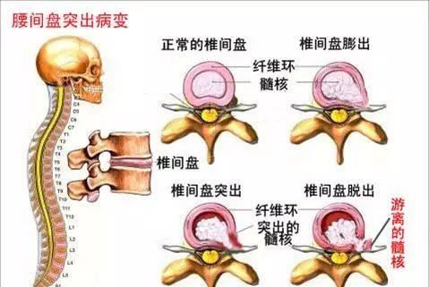 腰椎间盘突出患者需要吃药 NO,羊汤就可以帮你远离腰突