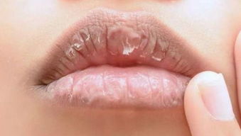 嘴巴周围干燥怎么弄好看 嘴唇干皮，唇纹应该怎么来护理