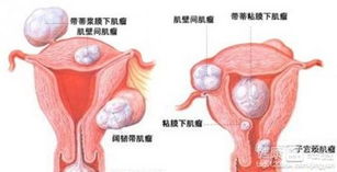 做子宫肌瘤手术要多少费用