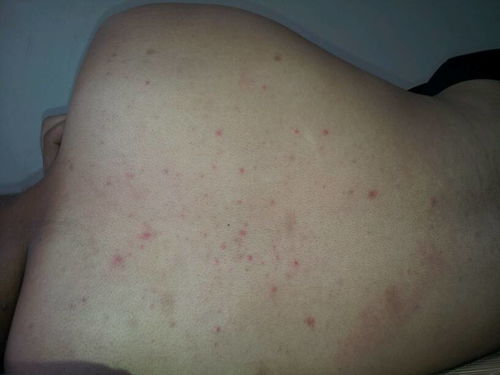 背上长了很多红斑红包,请问这是什么皮肤病还是其他病 