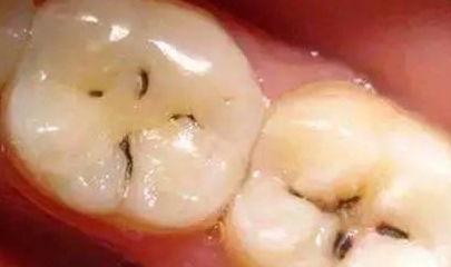 牙齿上出现怎么刷都刷不掉的黑线,这说明牙齿长蛀牙了吗