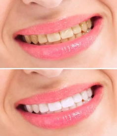 一口黄牙能毁掉最贵的口红,TA才是让颜值上涨的捷径