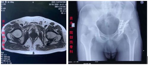 骨科是不是很少有手术失败死人的(现在骨科手术太泛滥了)