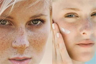 脸颊两侧长斑的原因 简单方法让你解决肌肤问题 