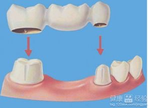 牙根坏了必须拔掉吗(牙根坏了必须拔掉吗镶牙需要多少钱)