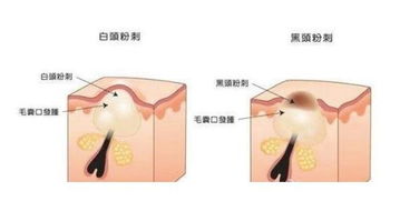 从根本上解决闭口粉刺痘痘的方法有哪些