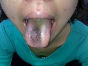感冒以后舌苔黑,感冒之后舌苔黑色是怎么了