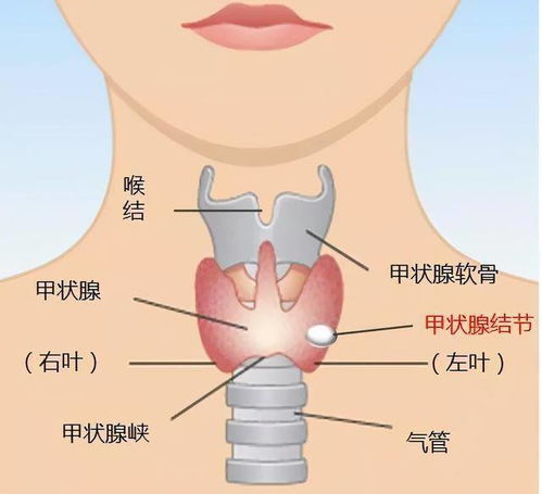 甲状腺低回声结节：揭秘成因、诊断与预防